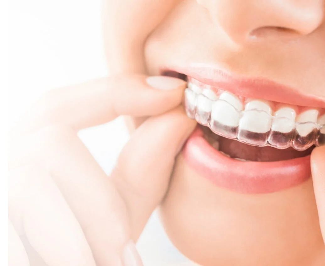 Invisalign Clear Aligners Bradford Wibsey Teeth Straightening Appointments Announced at Taylored Dental Care